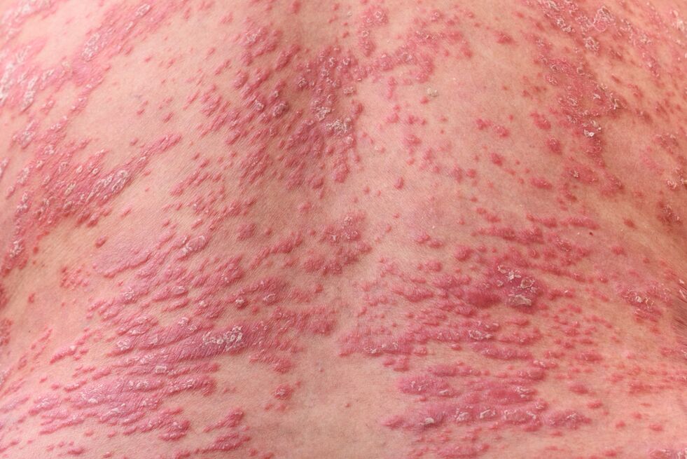 ¿Cómo se ve la psoriasis 